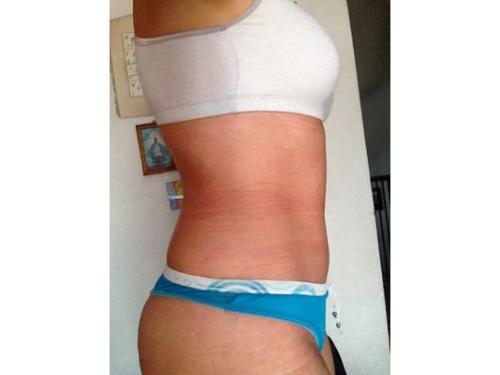 Después de tratamiento