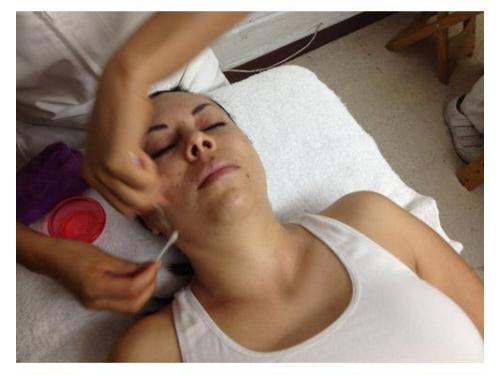 Tratamiento de peeling