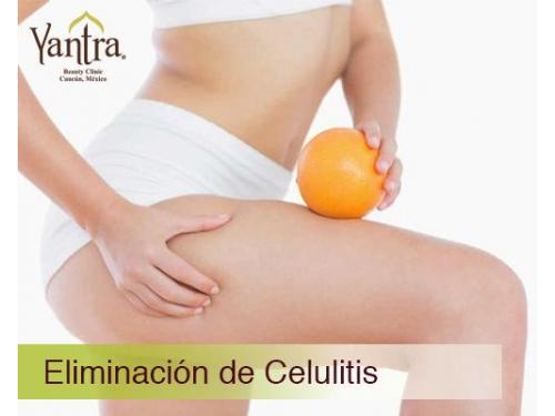 Celulitis