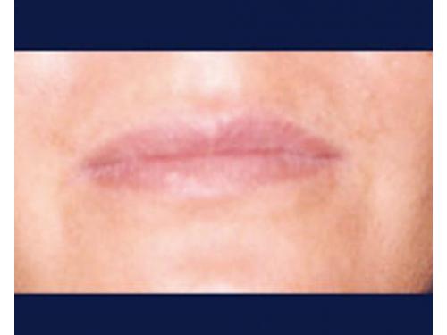 Aumento de volúmen labial con ácido hialurónico; antes