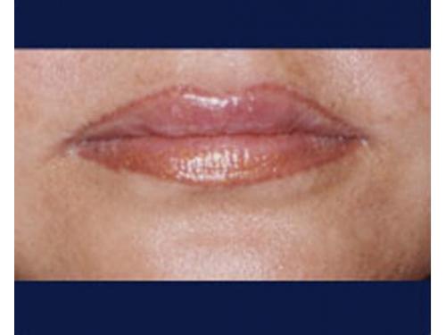 Aumento de volúmen labial con ácido hialurónico; después