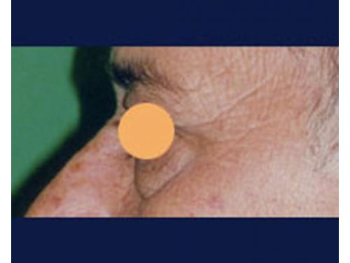 Blefaroplastía; antes