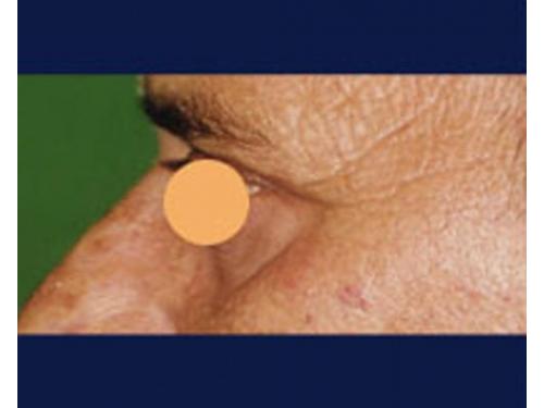 Blefaroplastía; después