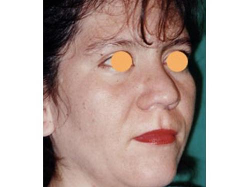 Lifting facial; antes