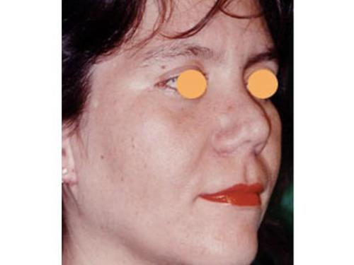 Lifting facial; después