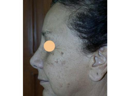 Rejuvenecimento facial láser erbium yag; antes