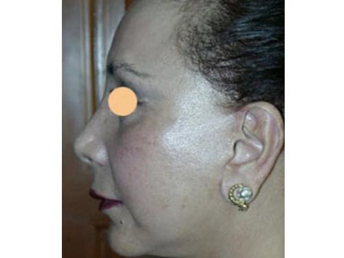 Rejuvenecimento facial láser erbium yag; después