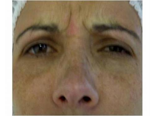 Antes después cejas y ojos