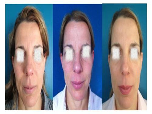 Tratamientos para novias