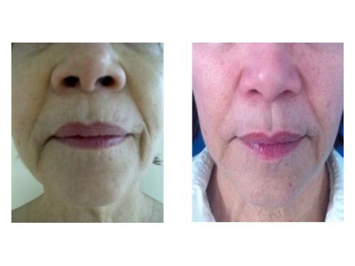 Tratamiento de rejuvenecimiento facial