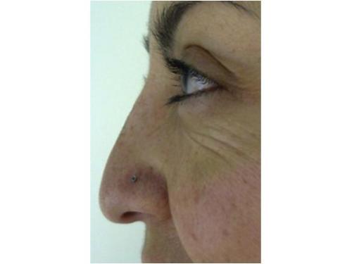 Borran líneas de expresión