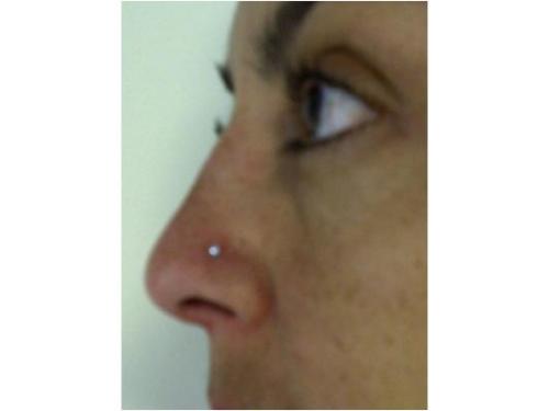 Borran líneas de expresión